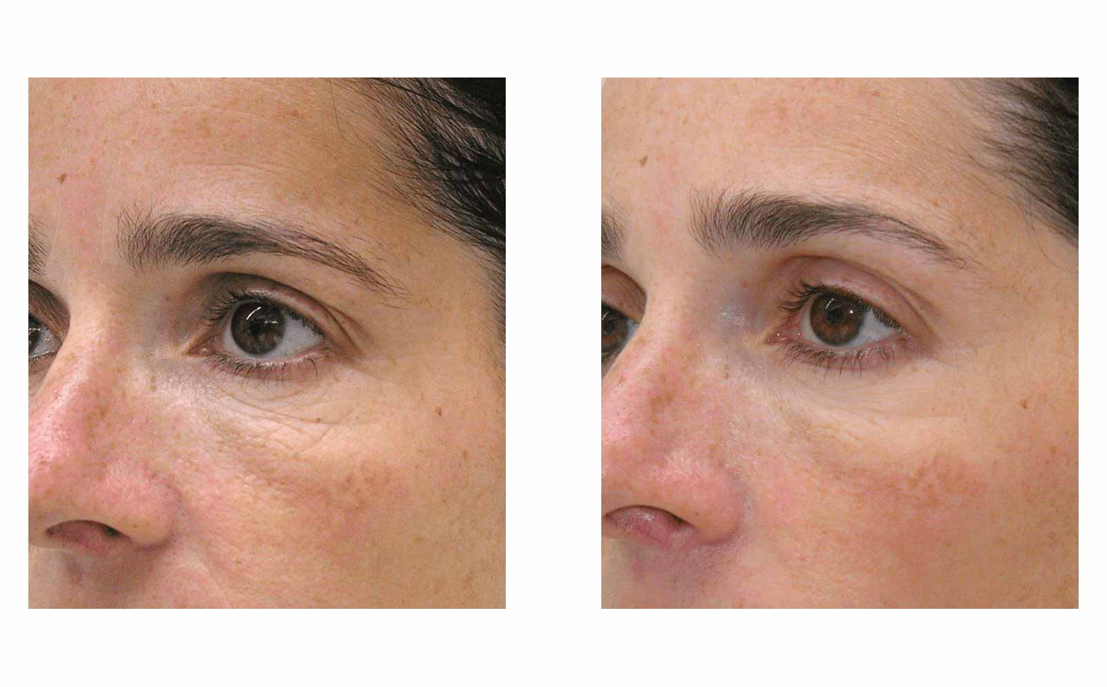 Mesotherapy Hill Street Clinic