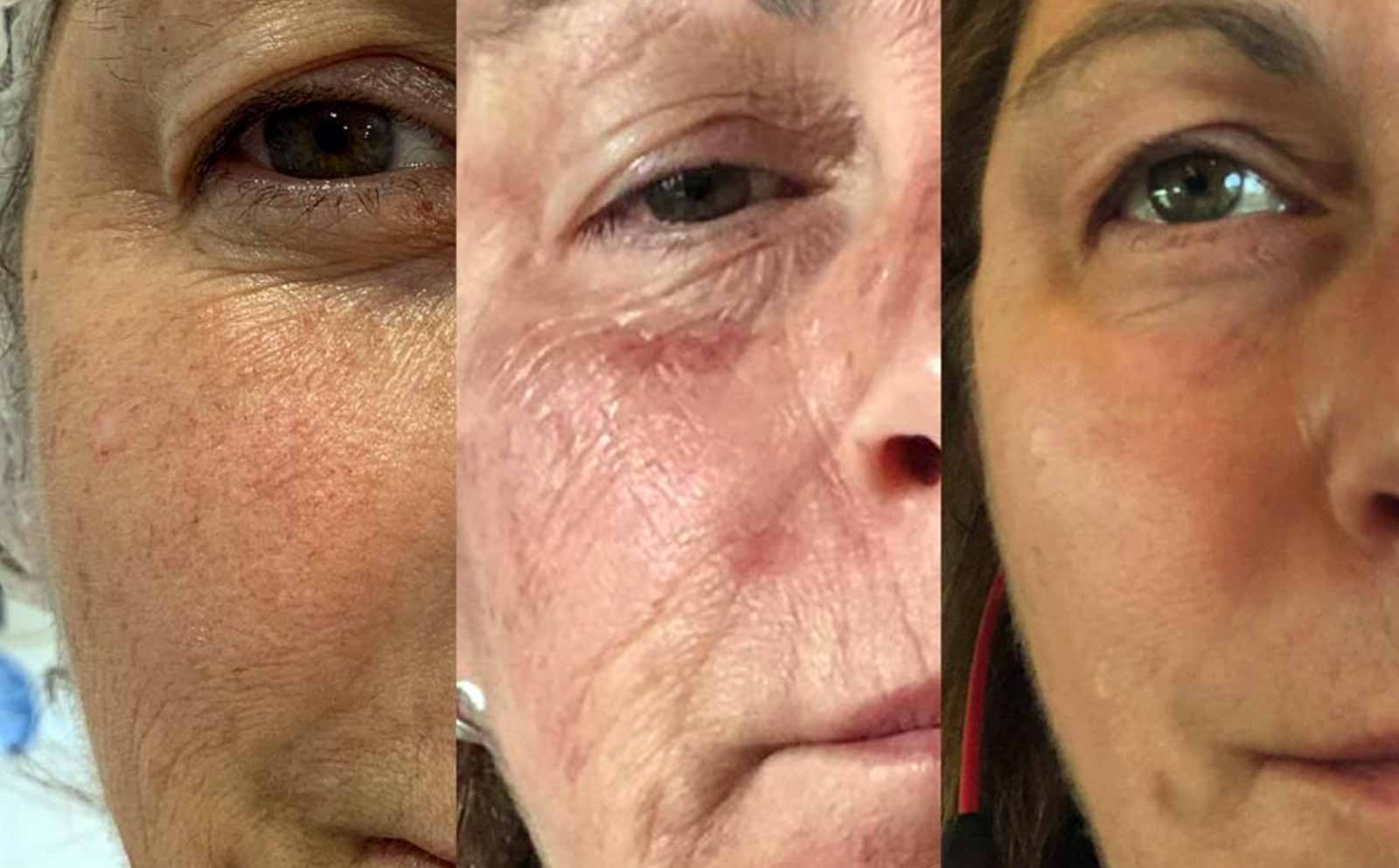 Chemical Peel Before & After