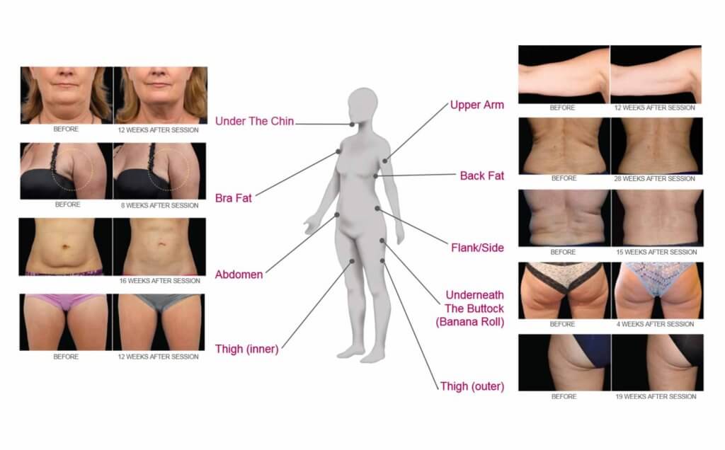 Coolsculpting treatment Before & After photos at 8 West Clinic