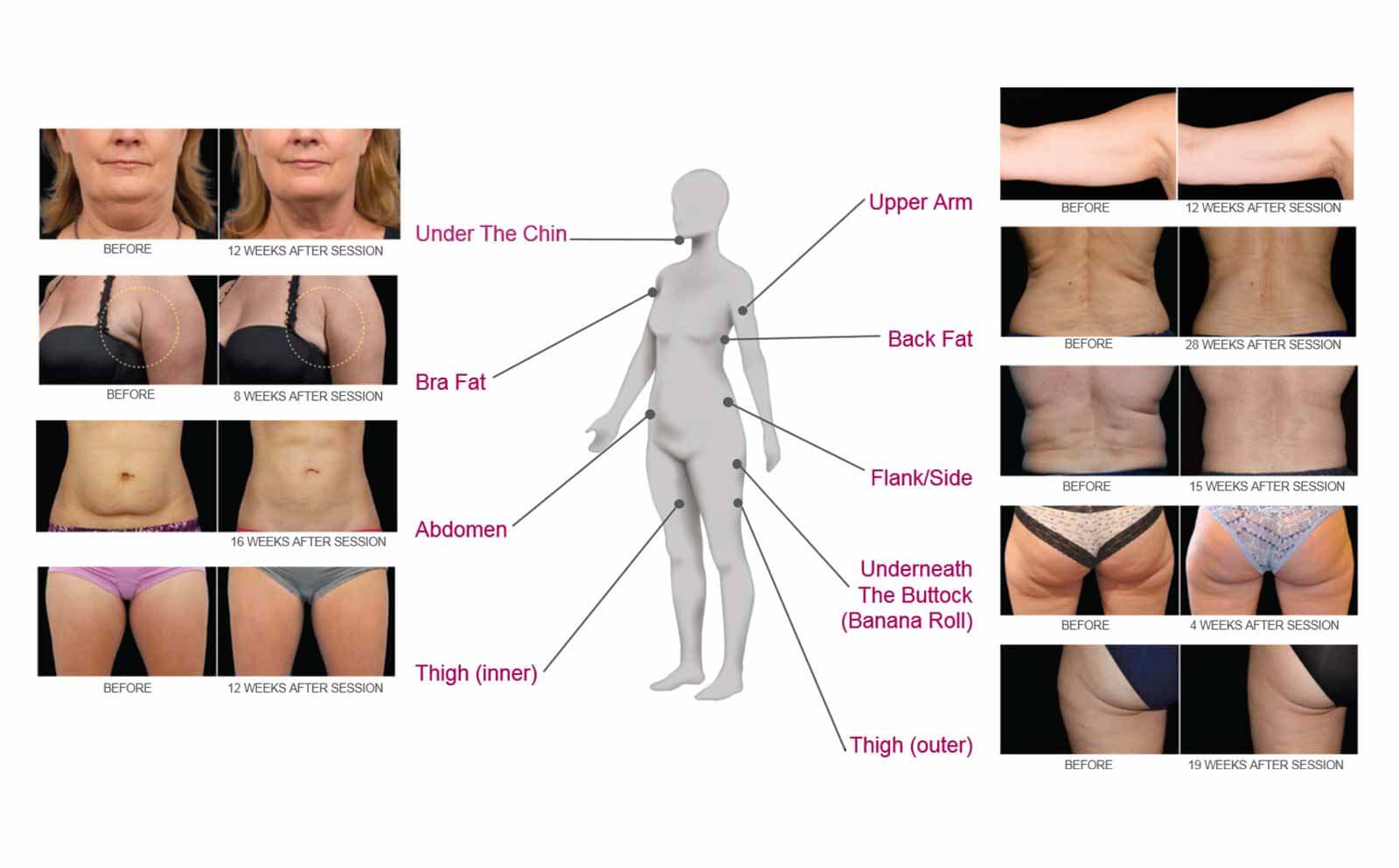 CoolSculpting Areas