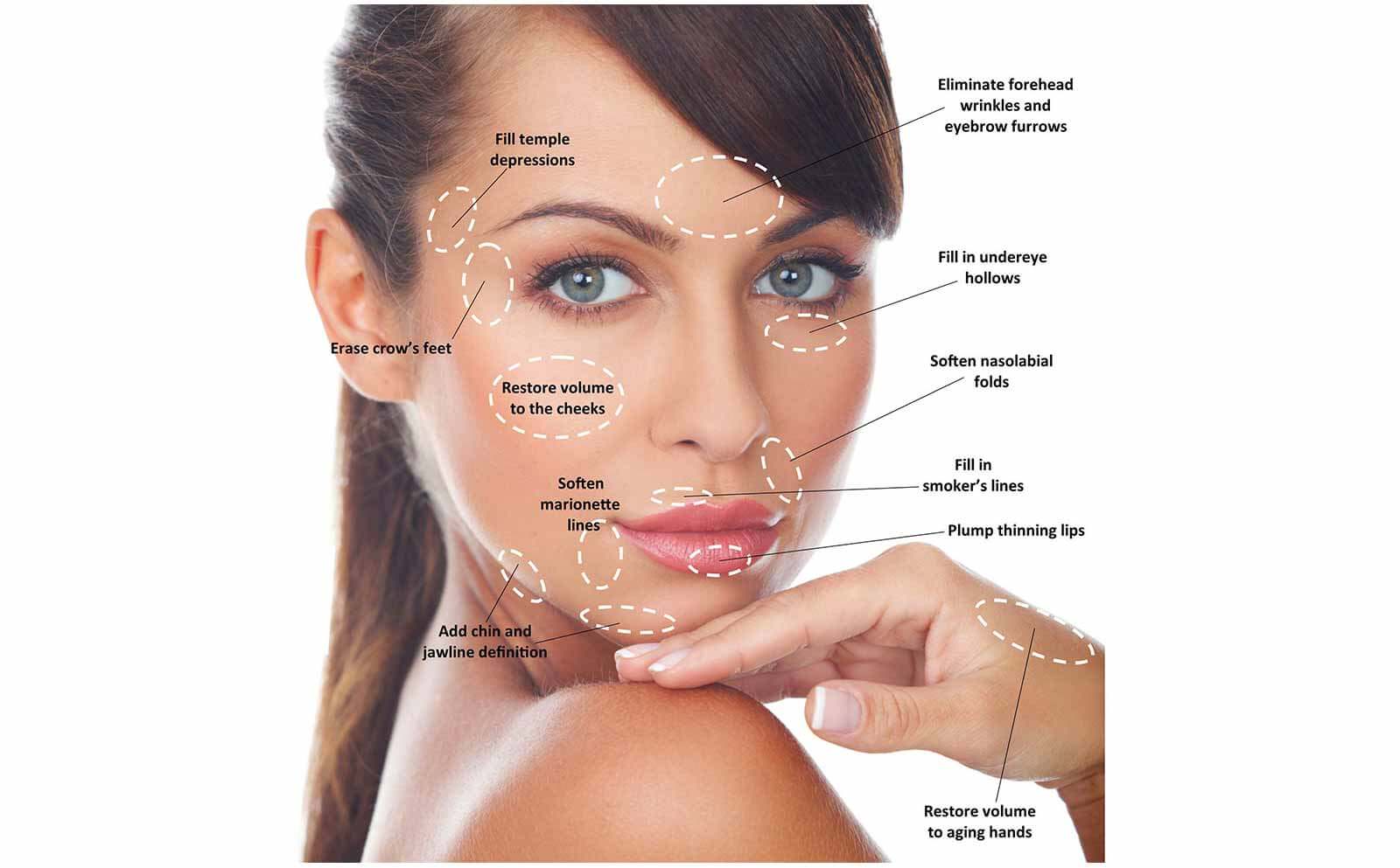 Dermal Fillers