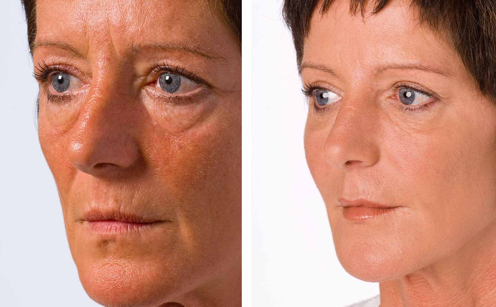 non-surgical-facelift-hill-street-clinic