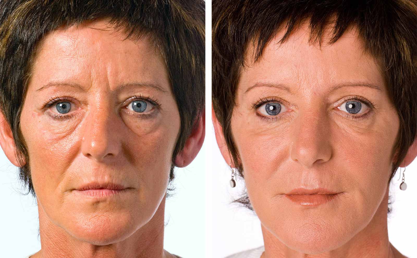 What Is A Non Surgical Facelift