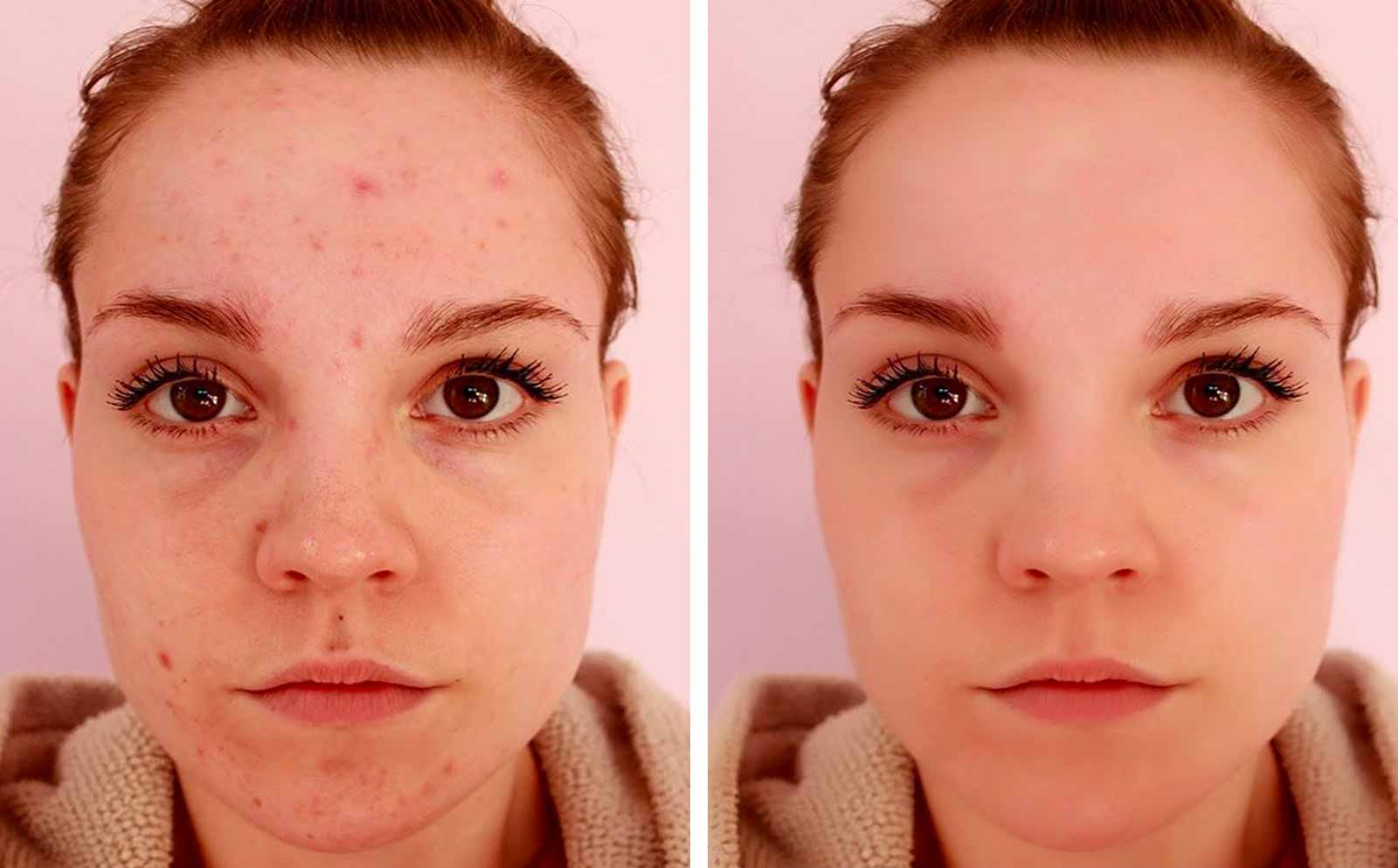 Skin Lesions & Blemish Removal