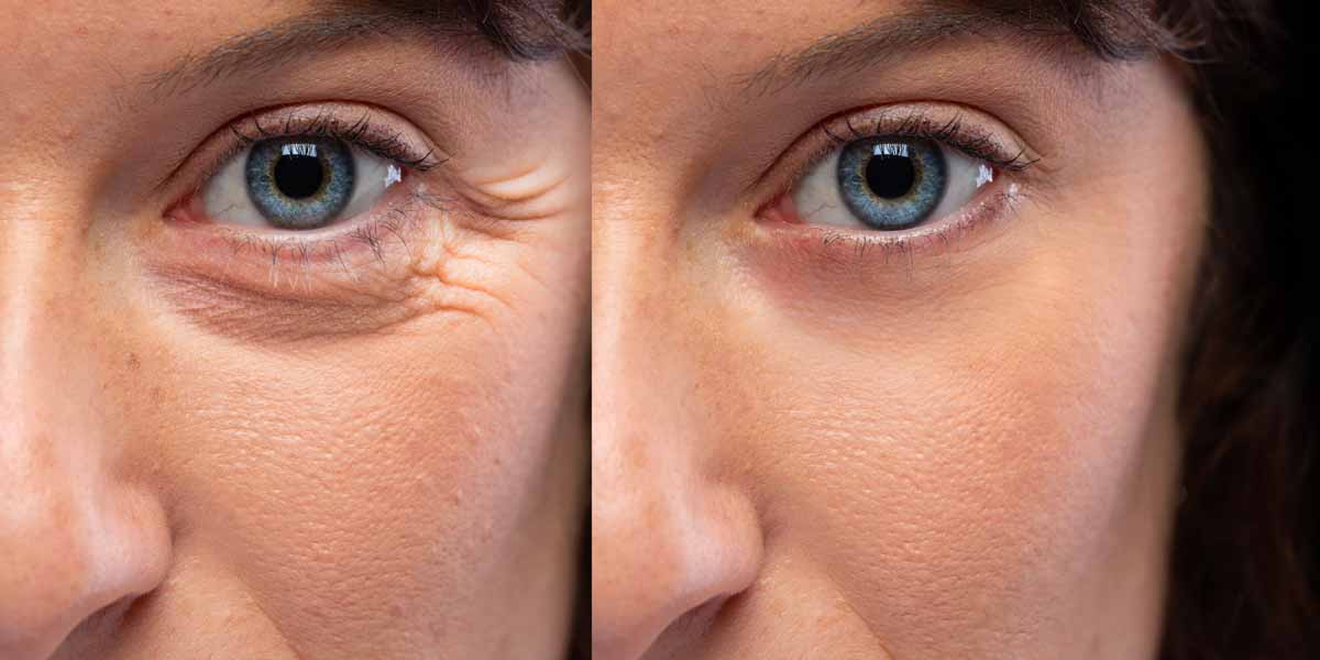 Sculptra treatment before and after