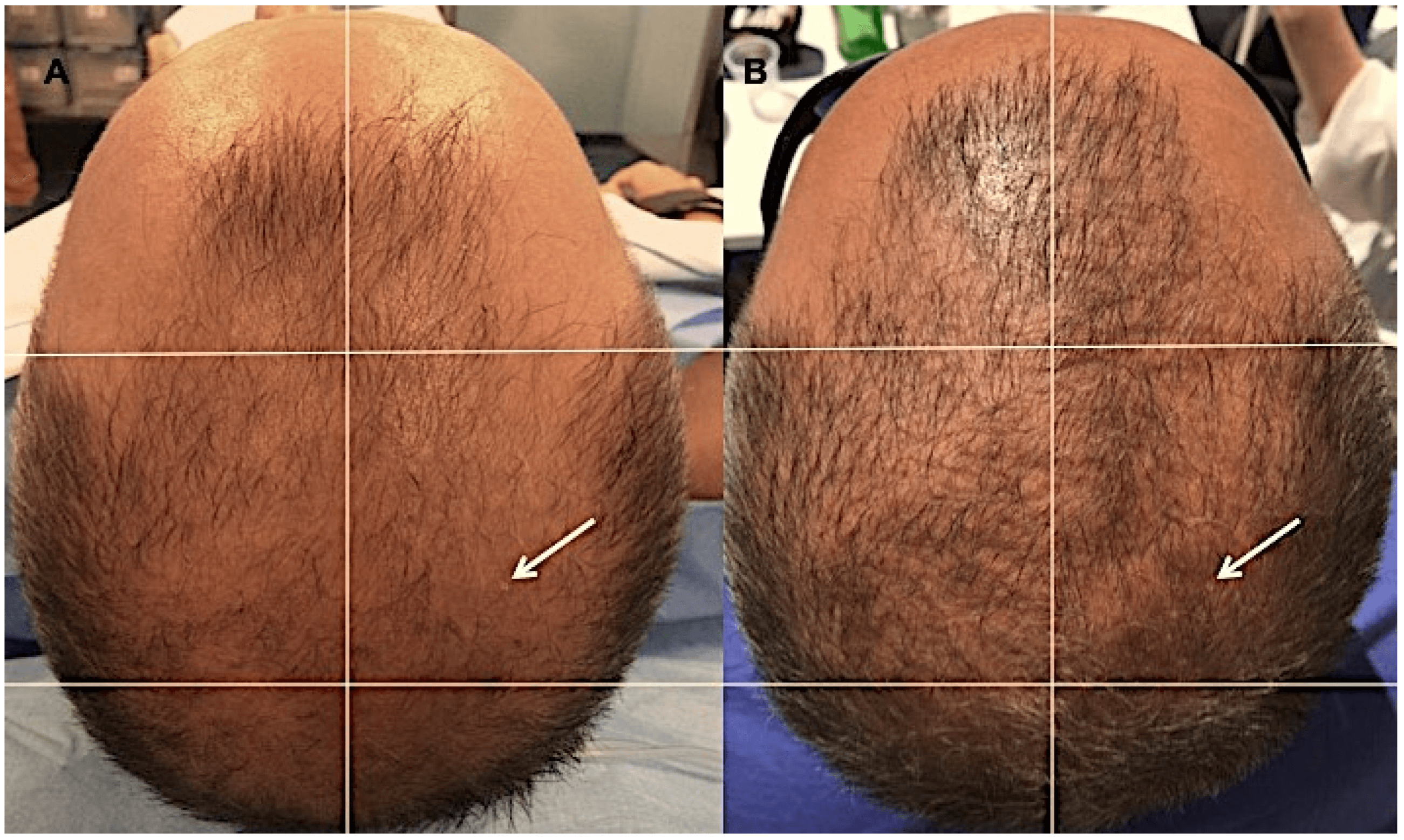 Autologous Hair Micrografting